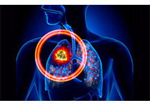 Targeted Medication Guidance for Lung Cancer